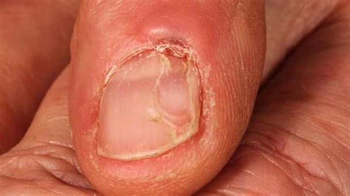 Do myxoid cysts hurt?