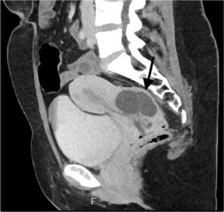Do nabothian cysts bleed?