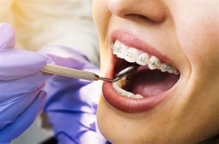 Do orthodontist clean teeth before braces?