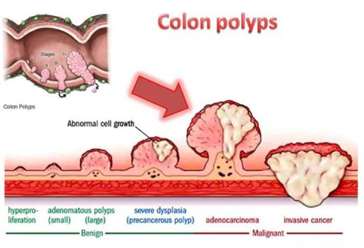 Do precancerous polyps bleed?