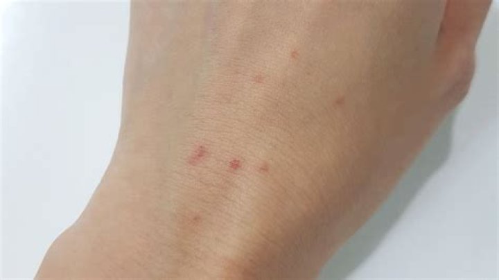 Do sea lice stay on you?