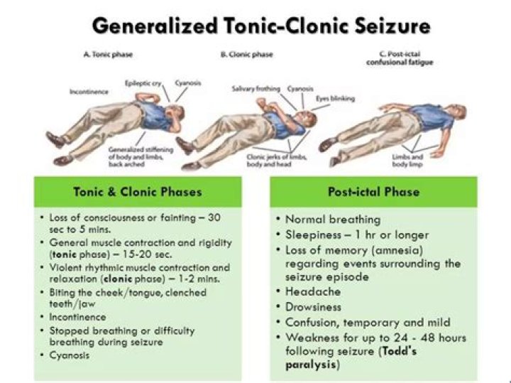 Do seizures cause unconsciousness?