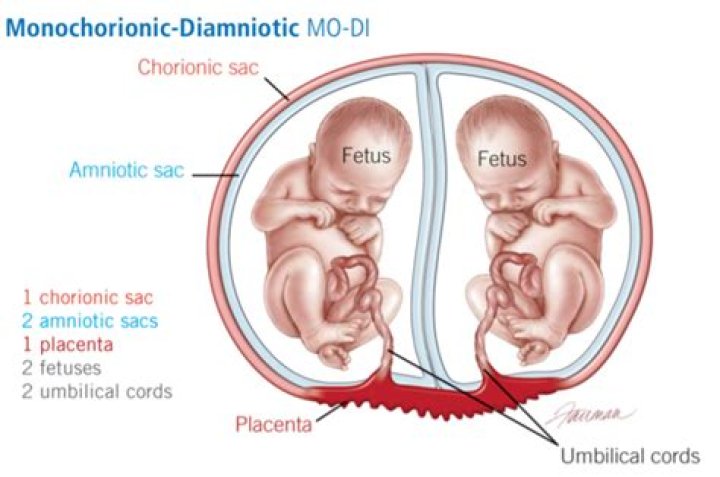 Do twins share amniotic sac?