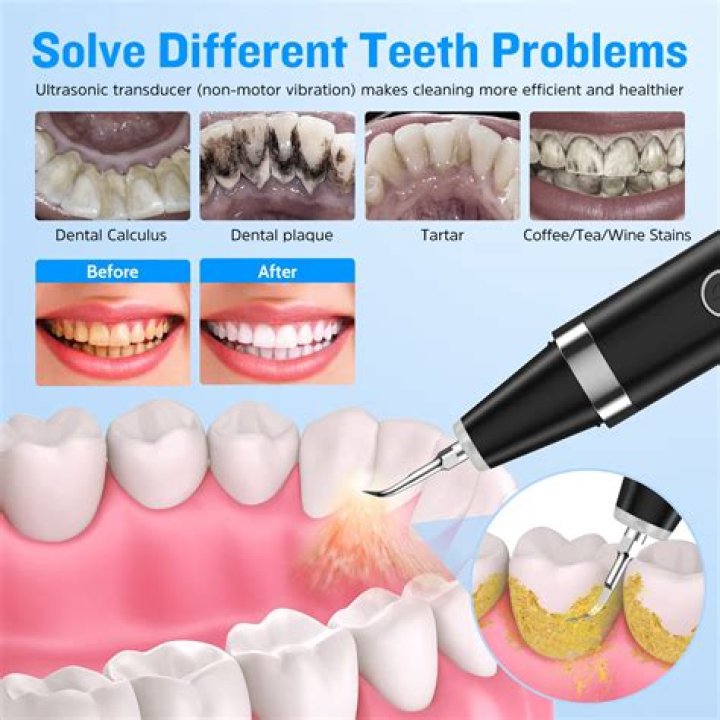 Do ultrasonic tooth scalers work?