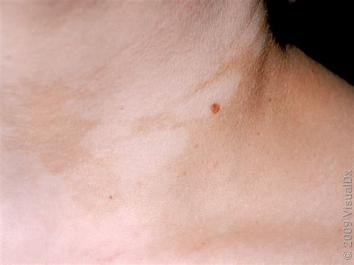 Do vitiligo spots change?