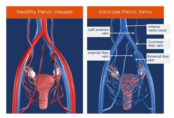 Do vulvar varicosities itch?
