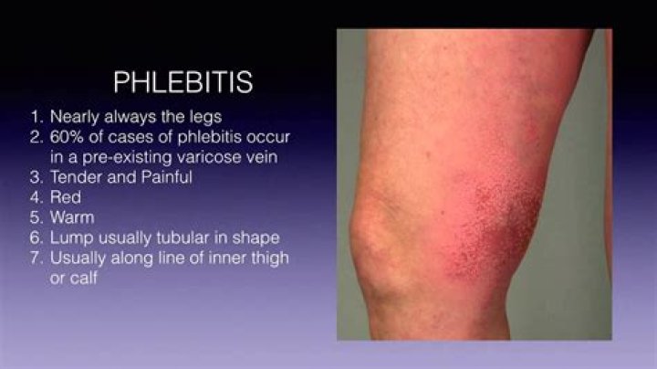 Do you treat phlebitis with antibiotics?