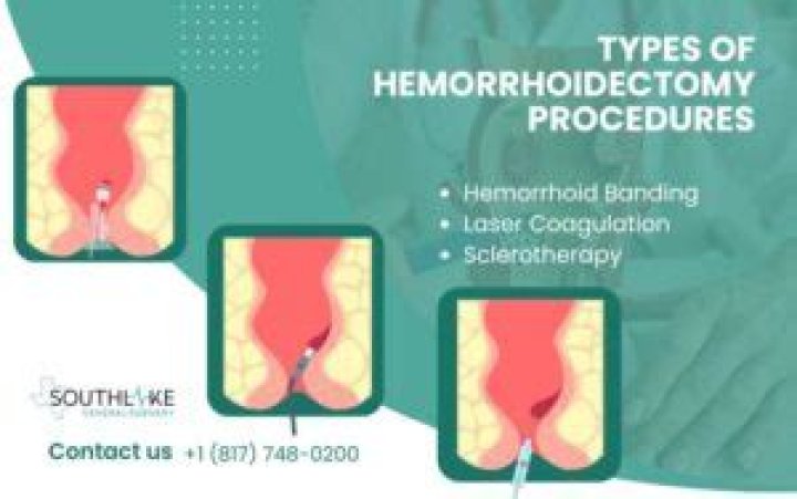 Does a thrombosed hemorrhoid require surgery?