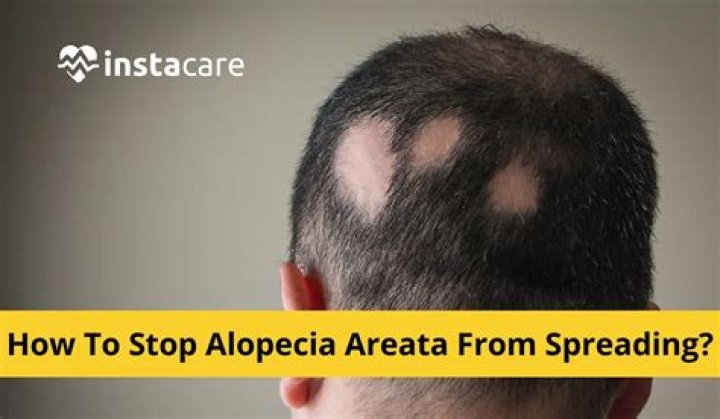 Does alopecia spread quickly?