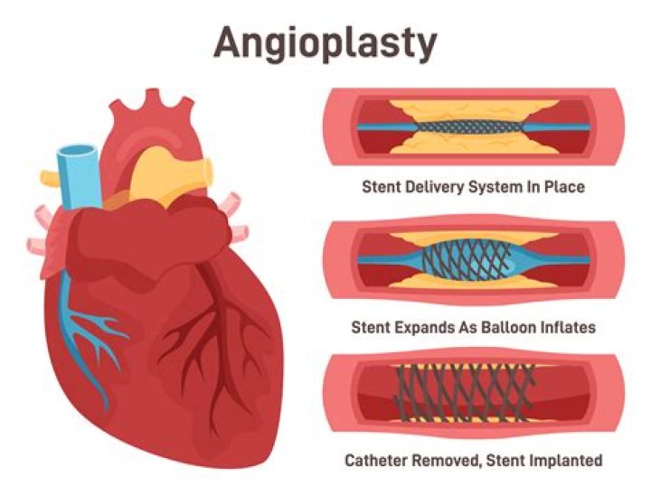 Does angioplasty prevent heart attack?