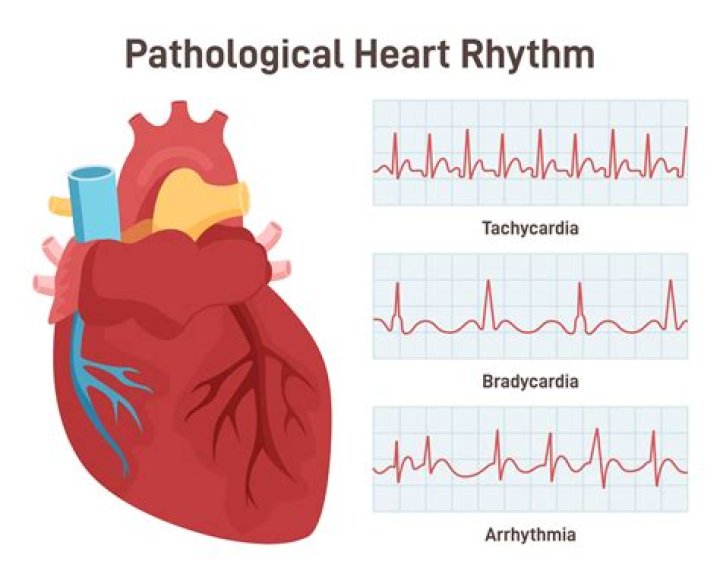Does arrhythmia cause fatigue?