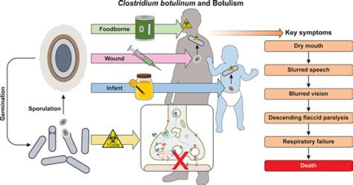 Does clostridium botulinum cause lockjaw?