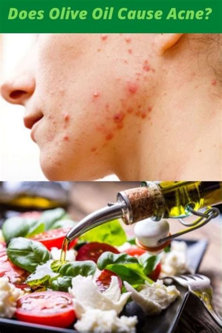 Does consuming oil cause acne?