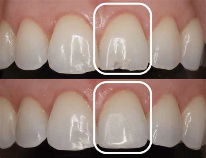 Does enamel repair itself?