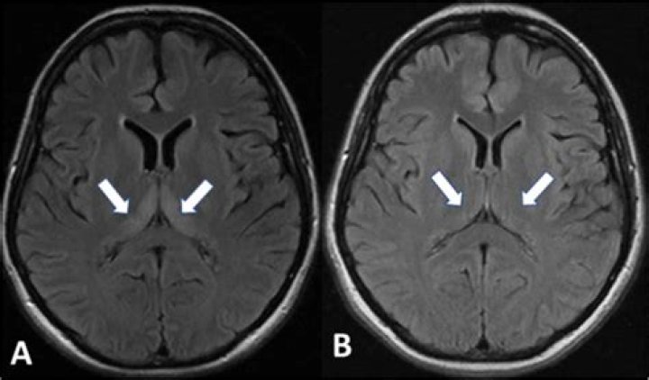 Does encephalopathy show up on ct scan?