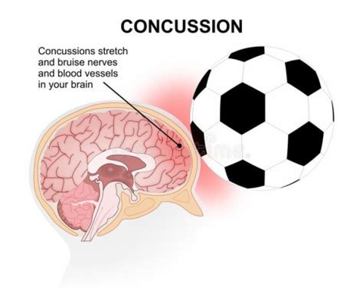 Does heading a soccer ball cause brain damage?