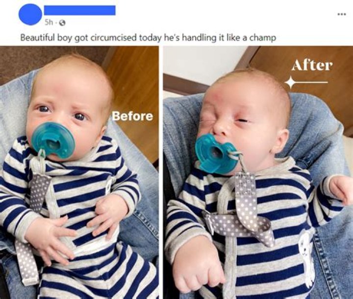 Does it hurt when a baby gets circumcised?