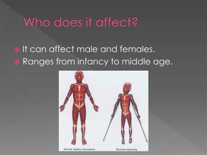 Does muscular dystrophy only affect males?