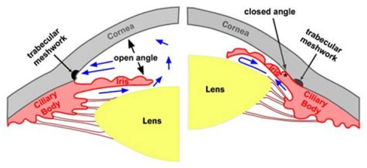 Does narrow angle glaucoma run in families?