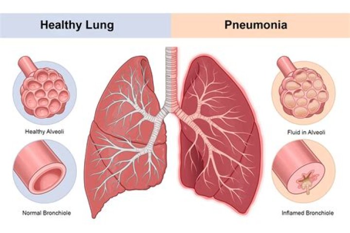 Does nocardia cause pneumonia?