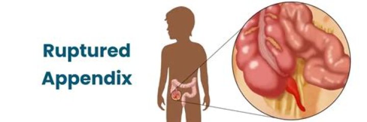 Does pain stop after appendix ruptures?