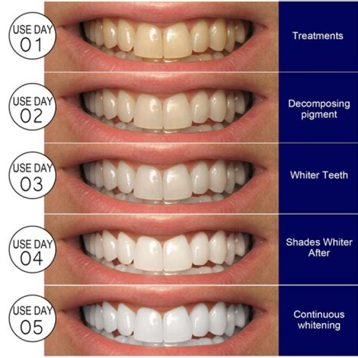 Does pearl whitening work?