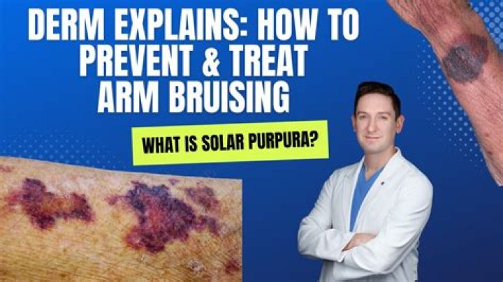Does rutin help with bruising?