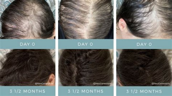 Does sirsasana regrow hair?