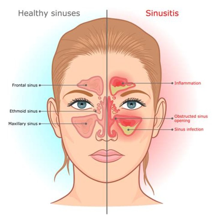 Does sphenoid sinusitis cause fever?