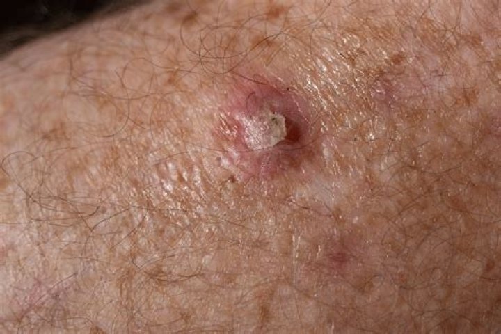 Does squamous cell carcinoma spread?