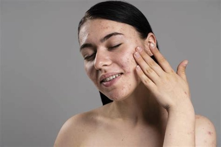 Does trinessa lo help acne?