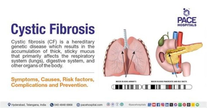 Has anyone with cystic fibrosis died from covid?