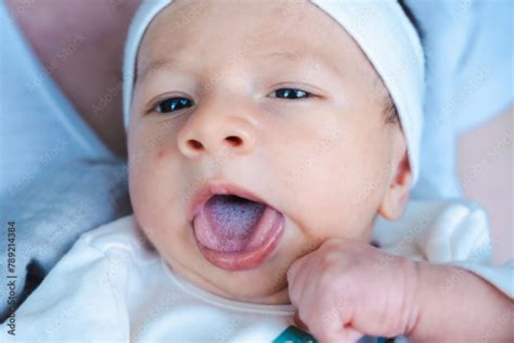 Has my baby got thrush?