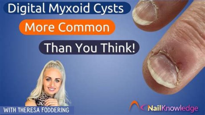 How common is myxoid cyst?