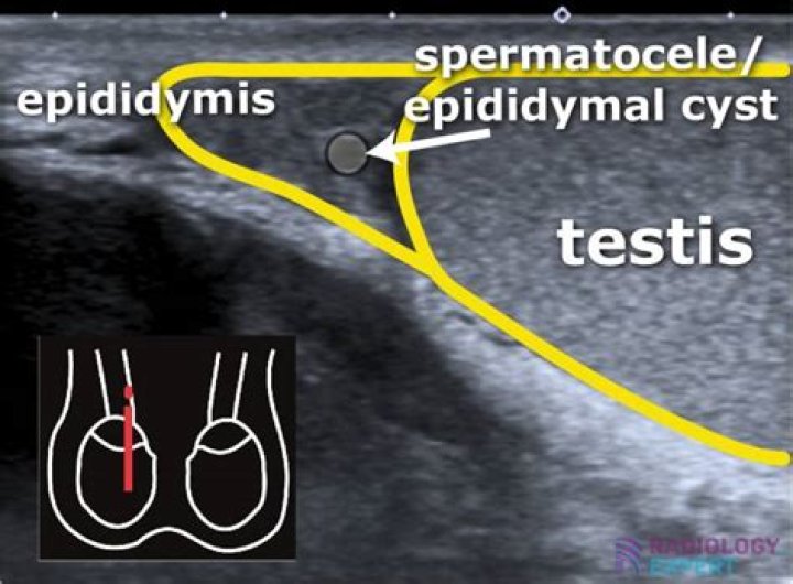 How do epididymal cysts form?