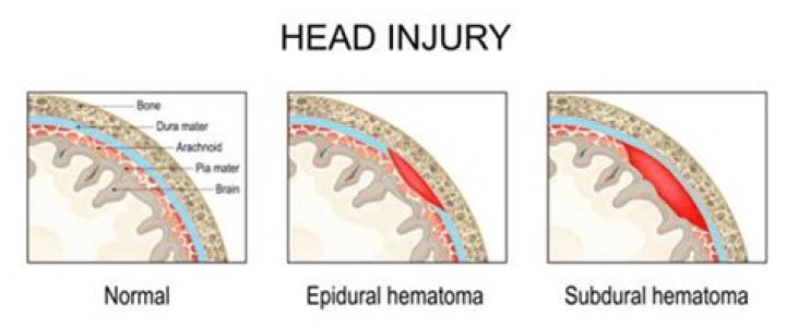 How does subdural hematoma affect body?