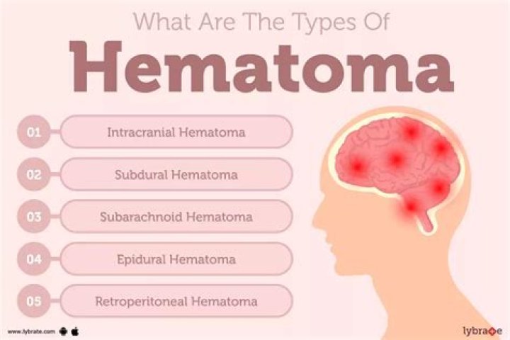 How hematoma is formed?