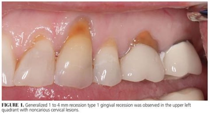 How is gingival recession treated?