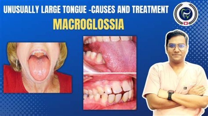 How is macroglossia causes?