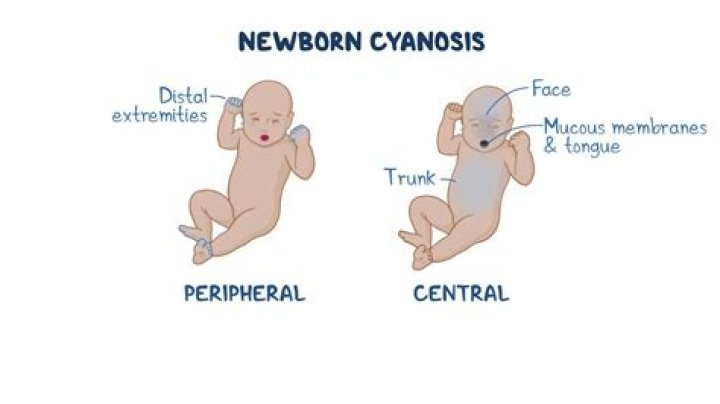 How long can acrocyanosis last in newborn?