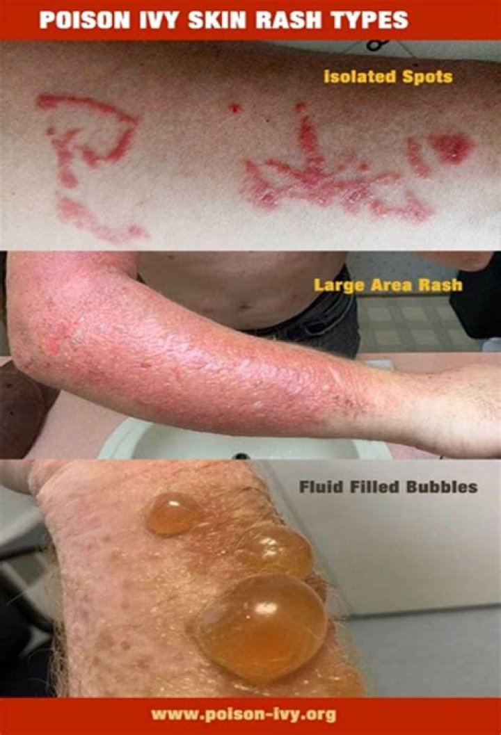 How long can urushiol stay on skin?