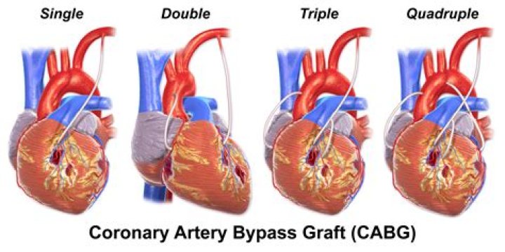 How long does a quadruple bypass take?
