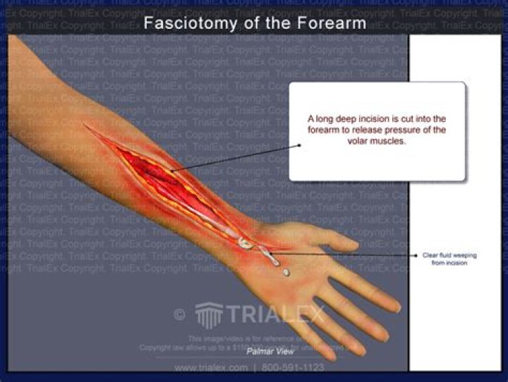 How long is recovery after fasciotomy?