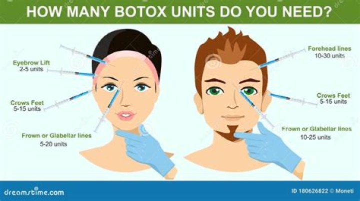 How much botox is needed for glabella?