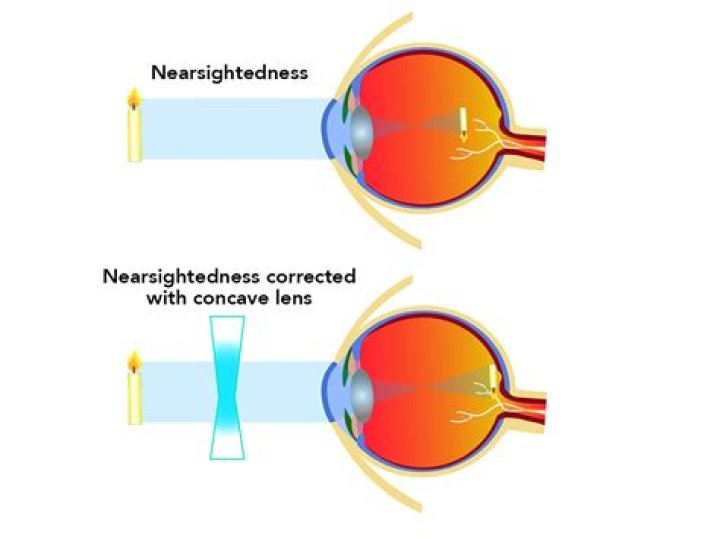 How to avoid long sightedness?