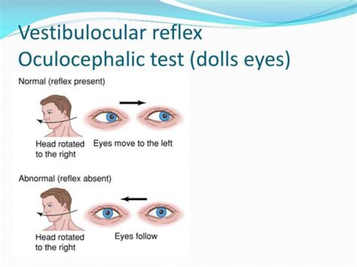 How to check oculocephalic reflex?
