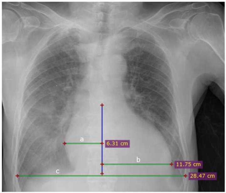 How to diagnose cardiomegaly on chest x ray?