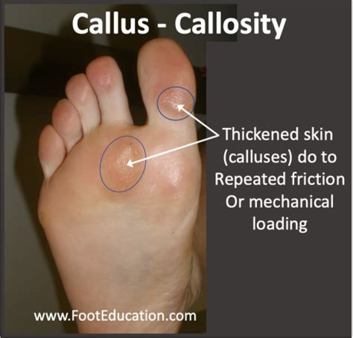 How to stop callosity?