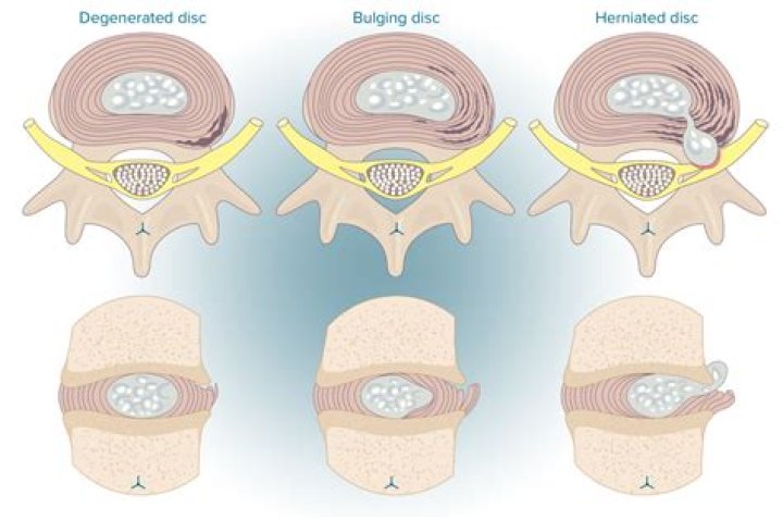 How to treat paracentral disc protrusion?