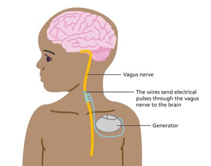 How to vagus nerve stimulation?